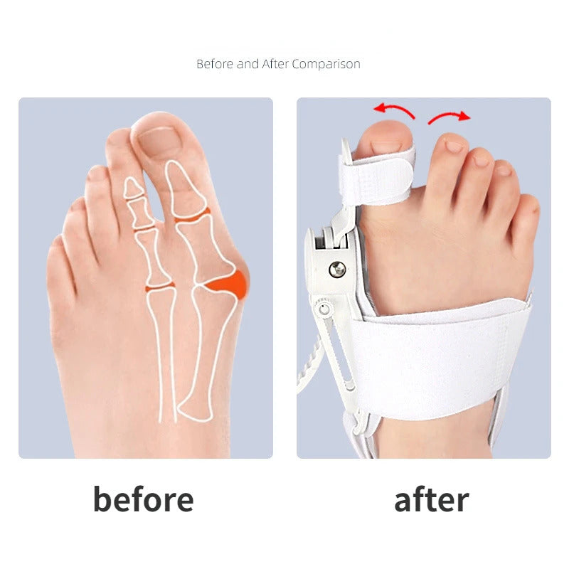 Silicone Toe Separator Bunion Corrector Splint Kit For Toe